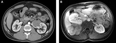 Clinical Characteristics and Treatment of Intra-abdominal Aggressive Fibromatosis: A Retrospective Study of 16 Patients